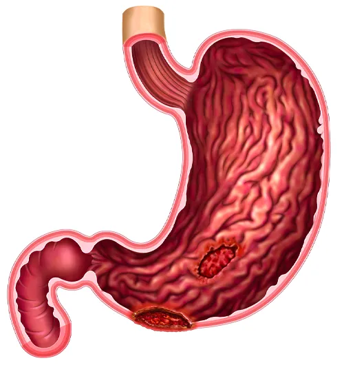 ناراحتی معده از عوارض جانبی داروی آسپیرین و امپرازول